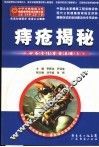 痔疮揭秘  告诉你如何面对肛肠疾病