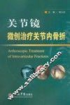 关节镜微创治疗关节内骨折